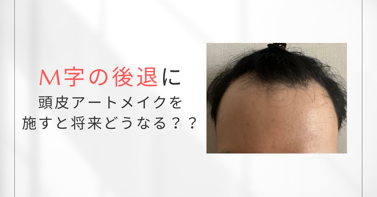 M字が後退してきた…果たして頭皮アートメイクは適応？？
