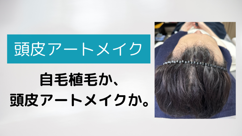頭皮アートメイク時下植毛か?頭皮アートメイクか?