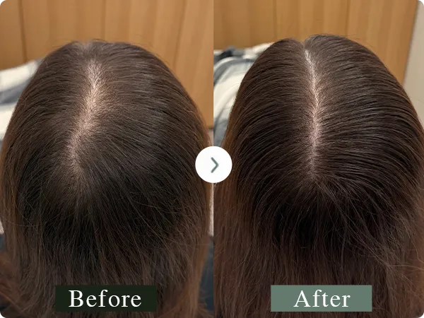 分け目の頭皮アートメイクの症例