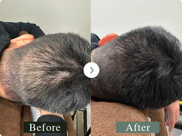 男性の傷跡修正の頭皮アートメイク症例